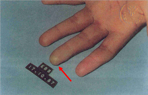 Blister at the finger tip