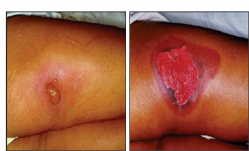 Clinical photo of blister and moist desquamation