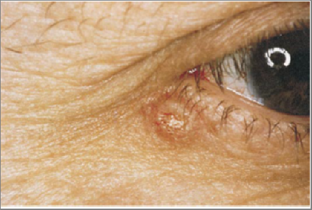 Clinical photo showing basal cell carcinoma of the eyelid