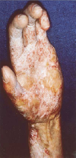 Clinical photo showing fibrosis, contractures, and keratosis