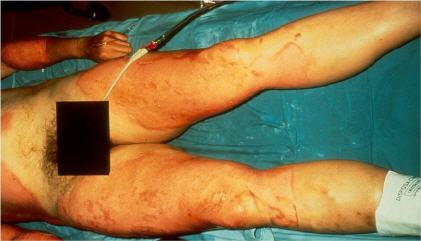 Industrial accident, shows erythema formation and early blistering
