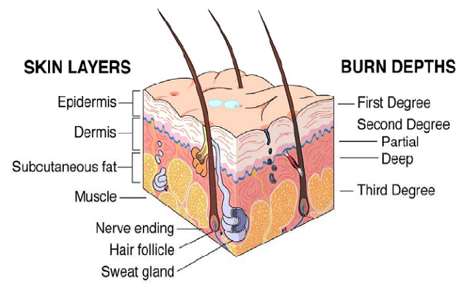 Skin Anatomy and Levels of Burn Injury - Radiation Emergency Medical  Management
