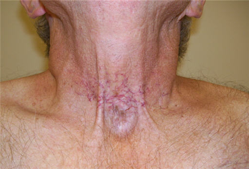 Clinical photo showing telangiectases and scarring