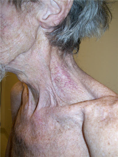 Clinical photo showing telangiectases and muscle contractures/fibrosis