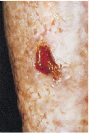 Clinical photo showing chronic radiation ulcer