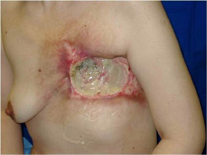 Deep radiation induced ulcer involving dermal and subdermal layers