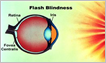 Flash blindness